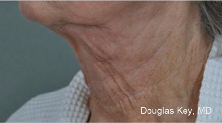 ThermiTight®: Patient 6 - After Image 1