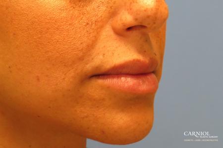 Lip Augmentation: Patient 1 - After Image 2