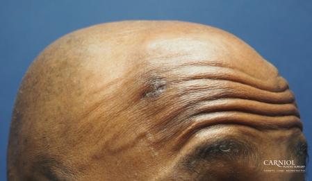 Mole/Age Spot Removal: Patient 3 - After Image 2