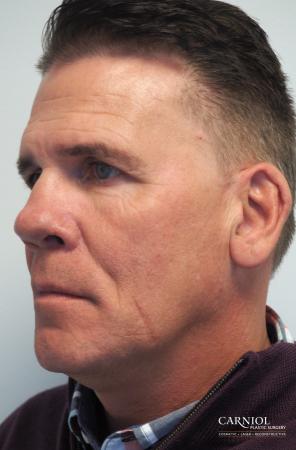 Non-Surgical Facelift: Patient 2 - Before Image 1