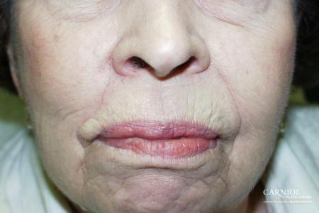 Skin Cancer Reconstruction - Face: Patient 7 - After Image 1