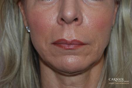 Facial Tightening: Patient 7 - After Image 1