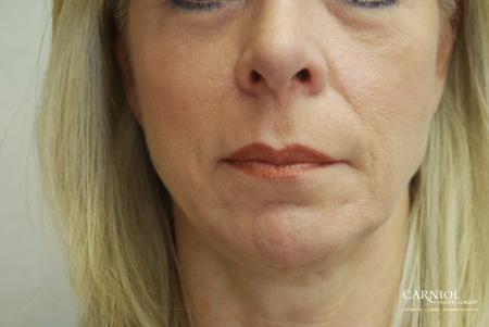 Facial Tightening: Patient 7 - Before Image 1