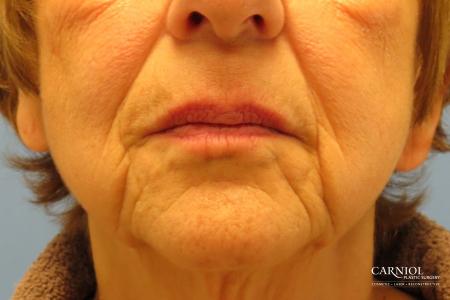 Non-Surgical Mini-Facelift: Patient 9 - Before Image 1