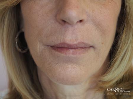 Fillers: Patient 4 - Before Image 1