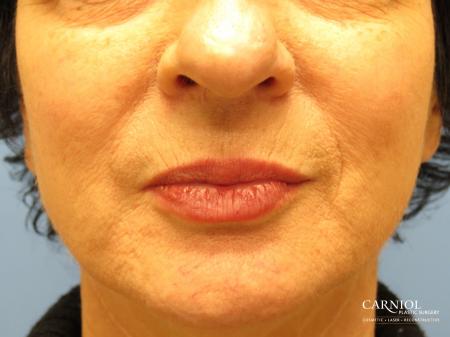 Lip Augmentation: Patient 6 - After Image 1
