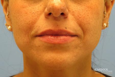 Scar Revision: Patient 3 - Before Image 1