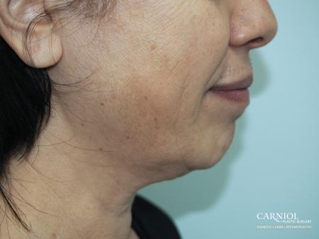 Facial Tightening: Patient 1 - Before Image 1