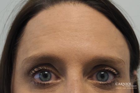 BOTOX® Cosmetic: Patient 4 - After Image 2
