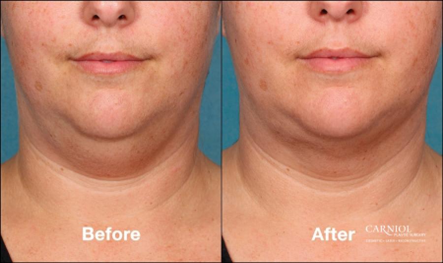 Double Chin, Kybella: Patient 1 - Before and After Image 1