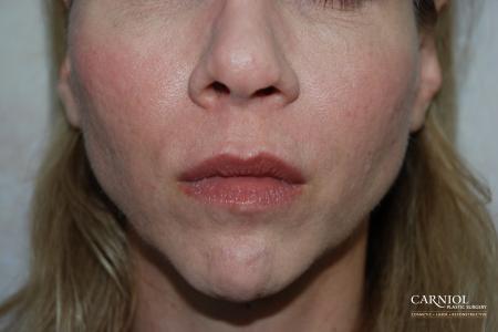 Facial Tightening: Patient 8 - After Image 1