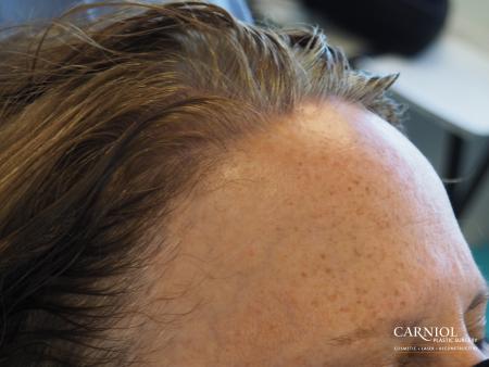 Nonsurgical Hair Restoration: Patient 1 - Before Image 2