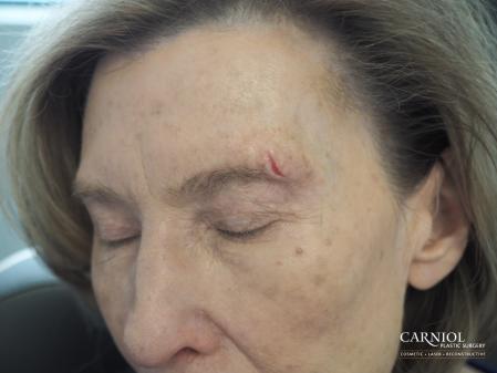 Scars: Patient 1 - Before Image 1