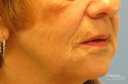 Non-Surgical Mini-Facelift: Patient 9 - After Image 2