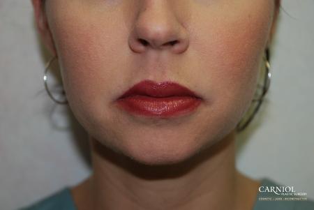 Lip Augmentation: Patient 3 - After Image 1