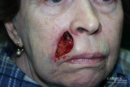 Skin Cancer Reconstruction - Face: Patient 7 - Before Image 1