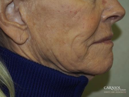 Facial Tightening: Patient 6 - After Image 1