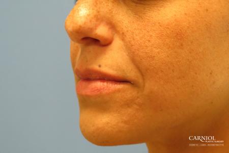 Lip Augmentation: Patient 1 - Before Image 3