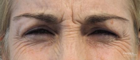 BOTOX® Cosmetic: Patient 5 - Before and After Image 3