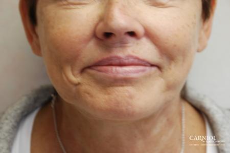 Lip Augmentation: Patient 4 - Before Image 1