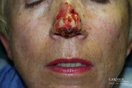 Skin Cancer Reconstruction - Face: Patient 2 - Before Image 1