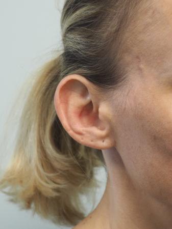 Otoplasty: Patient 3 - Before and After Image 5