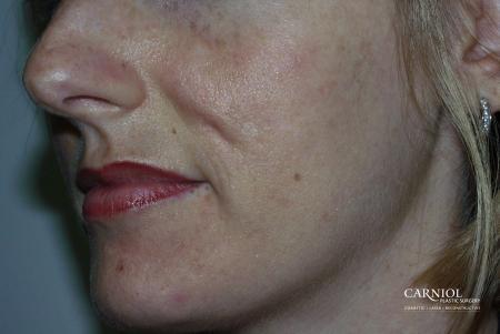 Acne Rejuvenation: Patient 2 - Before Image 1