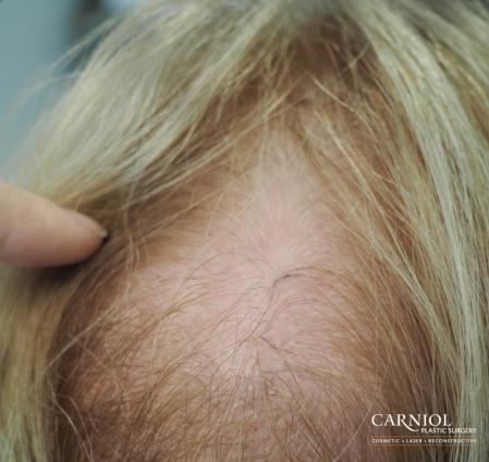 Nonsurgical Hair Restoration: Patient 3 - After Image 1