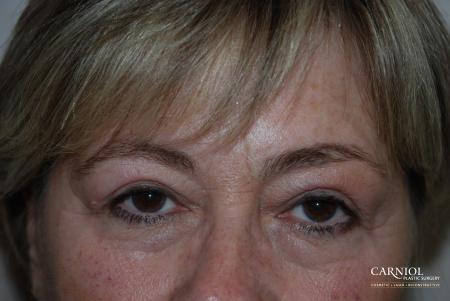 Upper Blepharoplasty Before - After Image 1