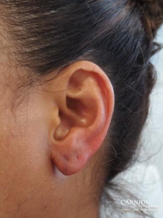 Earlobe Surgery: Patient 1 - After Image 1