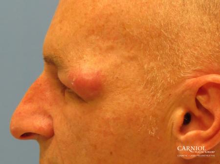 Eyelid Surgery: Patient 1 - Before and After Image 3