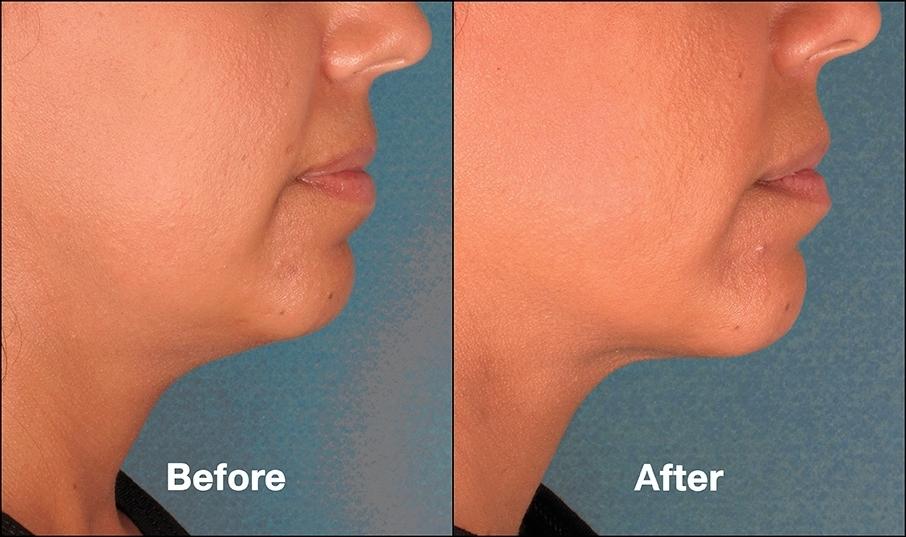 Double Chin, Kybella: Patient 3 - Before and After  