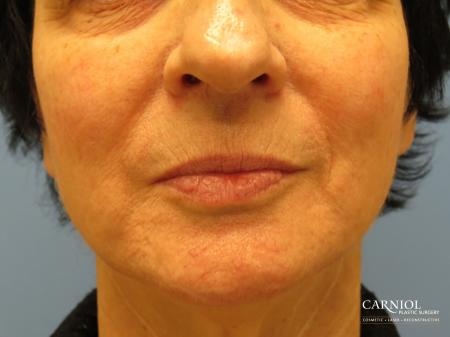 Lip Augmentation: Patient 6 - Before Image 1