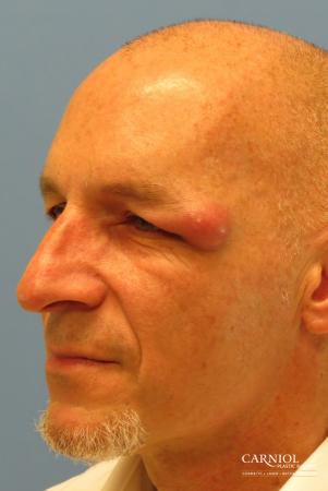 Eyelid Surgery: Patient 1 - Before Image 2