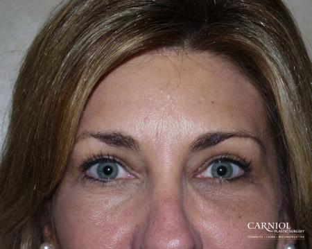 Fillers: Patient 3 - Before Image 1
