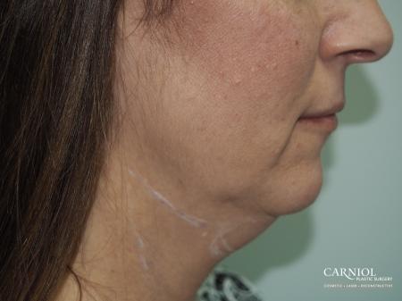 Non-Surgical Neck Lift: Patient 1 - Before Image 1