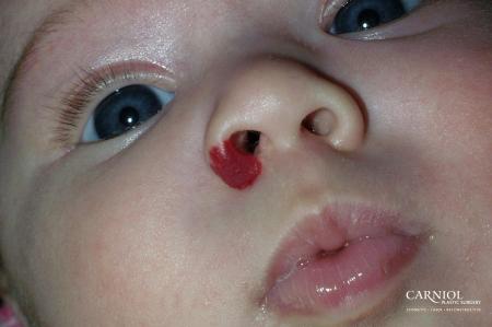Hemangioma: Patient 2 - Before Image 1
