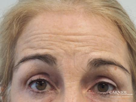 BOTOX® Cosmetic: Patient 5 - Before Image 2