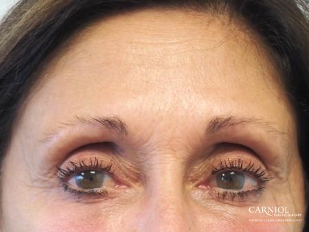 BOTOX® Cosmetic: Patient 6 - Before Image