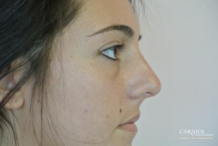 Rhinoplasty: Patient 3 - After Image 1