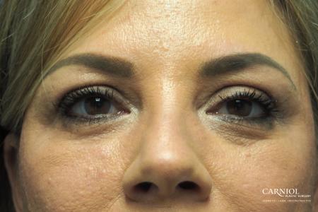 Blepharoplasty: Patient 2 - After Image 1