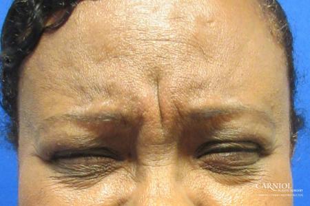 BOTOX® Cosmetic: Patient 3 - Before Image