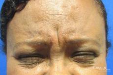 BOTOX® Cosmetic: Patient 3 - Before Image