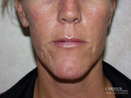 Acne Scars: Patient 1 - Before Image 1