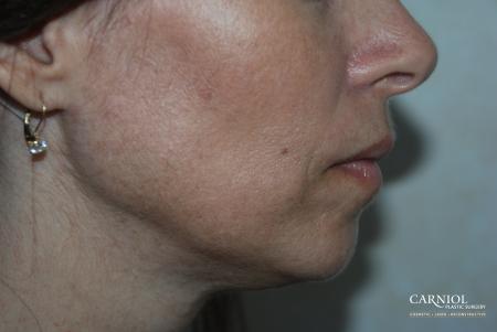 Fractional Resurfacing: Patient 2 - After Image 1