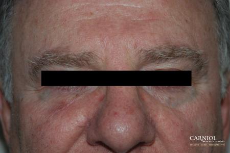 Skin Cancer Reconstruction - Face: Patient 4 - After Image 1