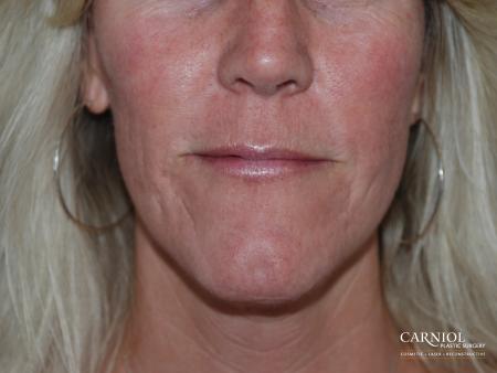 Acne Scars: Patient 1 - After Image 1