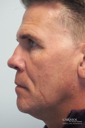 Non-Surgical Facelift: Patient 2 - Before and After Image 3