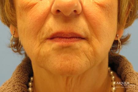 Non-Surgical Facelift: Patient 1 - After Image 1