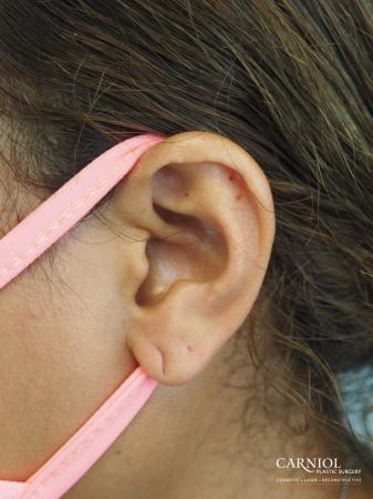 Earlobe Surgery: Patient 1 - Before Image 1